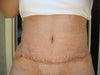 2 wk post op TT scar