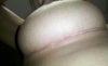 The scar is the full width of the crease under my breast and is not as bad on my other breast