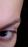 Fine horizontal lines-should I botox?