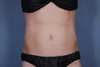 Liposonix Before and After Photos