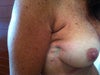 Right breast profile (gathered skin)