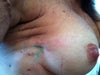Right breast profile (gathered skin)
