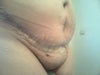 2 weeks after tummy tuck.