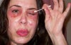 Day 4 of CO2 Laser eye resurfacing.