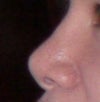 before revision rhinoplasty