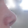 sideview, after surgery