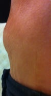 side view showing lump to the left of belly button