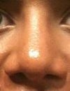 This is the picture I took after the cast came off, after my rhinoplasty.