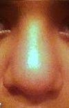 This is how my nose looks now 6 months after rhinoplasty. It looked so good 1 month before. (The first picture)