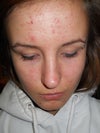 forehead/whole face
