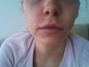 lip lift candidate?