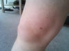 knee