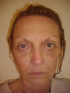 LOWER EYES HANGING AND BLUE DISCOLORATION UNDER EYES 3 MOS AFTER EYE LIFT