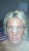 This pic looks bad..lol but only five days post op.