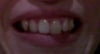 My teeth now, My canine is slightly out and would like to push in slightly.