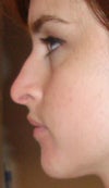 My nasal spine is really close to my upper lip