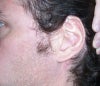 Left ear