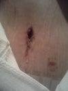 Belly button 13 days post op