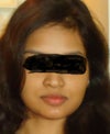 Before surgery.My fuller cheeks