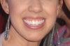 gummy smile- 26 yr old female