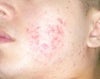 p.i.h is 3 months old retin and hydroquinone its working to slow