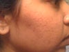 Before Acne Scar