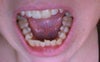 Lower frontal teeth area