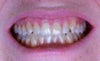 Visible teeth
