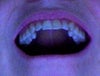 Upper teeth