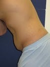 before lipo
