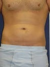 before lipo