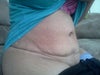 11 weeks sitting down, this is why I had the surgery to begin with.
