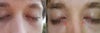 Pictures showing my eyelid closure problem.
