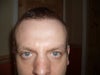 nose six weeks post closed rhinoplasty