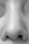Front view; 3 months post op