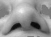 Smiling - Base view, 3 months post op