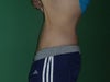 Before body lift, stretching the extra skin up