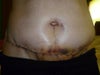 Extremely painful swelling! (this pic is 5 days post op)