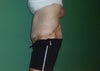 5 days post op