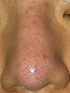 Nose veins and redness after juvaderm