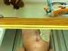 Six weeks after an emergency colectomy.  The belly protrudes in the front and the belly button is somewhat misshapen.