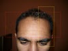 the area in yellow is where my forehead looks out of whack. Im bothered by the imbalance in facial symmetry on the right side of my forehead compared to the left.
