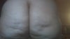 butt augmentation