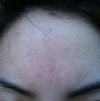 Pic of the bumps on the forehead.  The pic is not clear so the severity of the bumps don't seem to show.