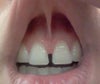 My Dr. claims no need to cut string under lip bcuz it's shifted upward throughout the yrs. ???