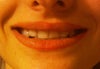 Previous permenant lip liner complicates the problem and may be contributing. But the "lopsidedness" is also on the inside of both lips.