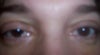 Ptosis????