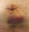 Bruising and dots around belly-button, 5 days after surgery