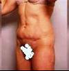 before ...thought sides and front would help suspend but all this was removed and thin pelvic slope skin pulled up to hold everything together.