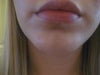 the chin implant really filled out my chin area, but I want more length.